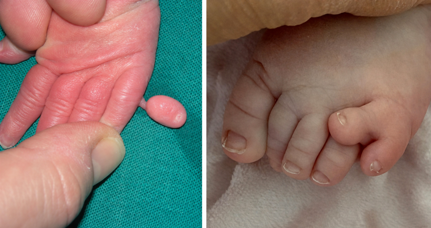 Postaxial polydactyly Type B in newborn hand and foot