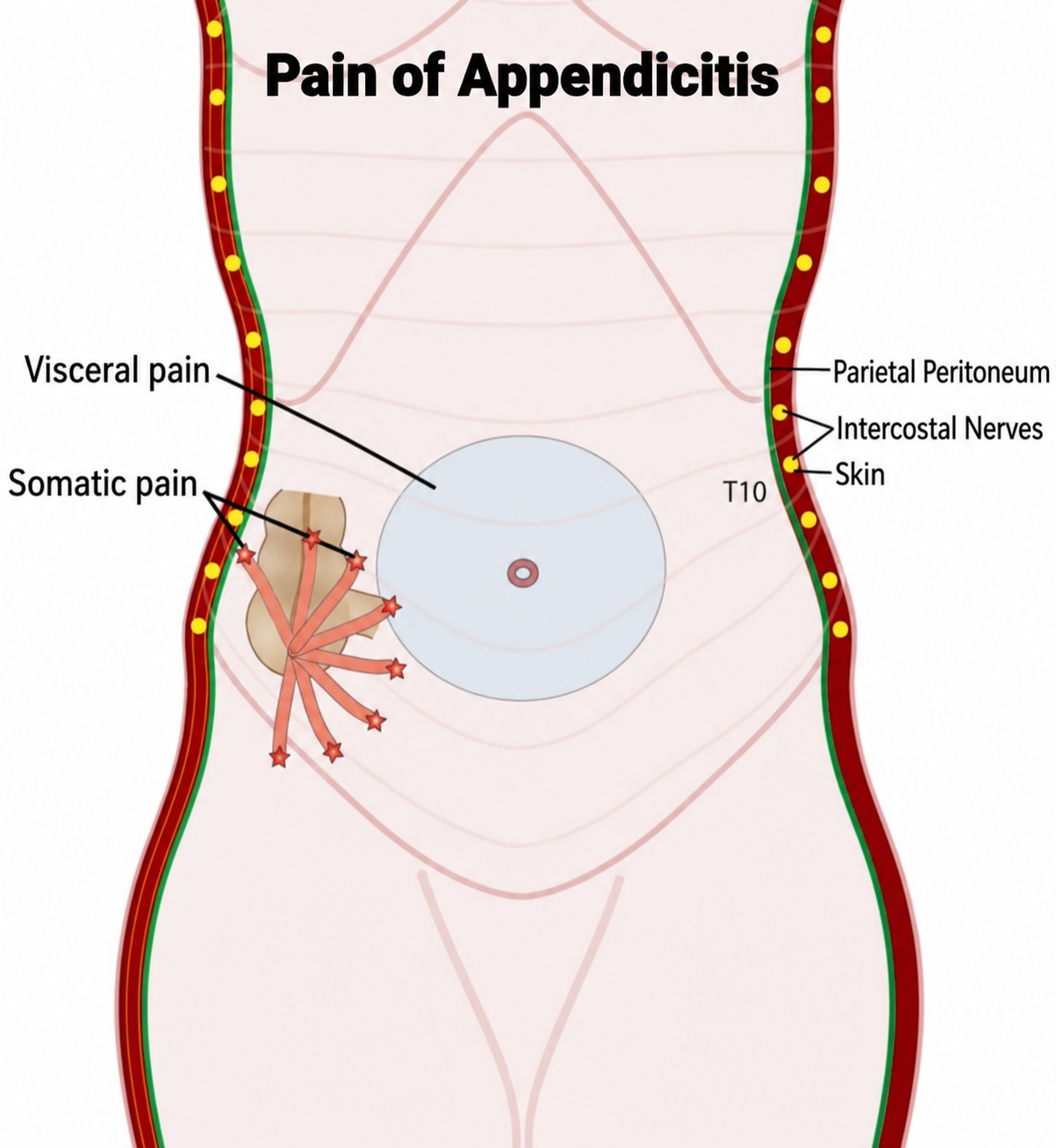Appendicitis pain migration pattern from periumbilical to right lower quadrant
