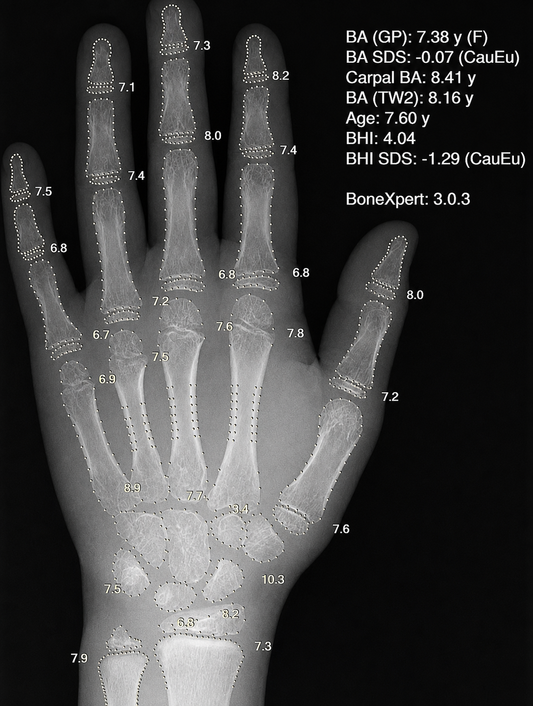 Bone age assessment X-ray with BoneXpert overlay