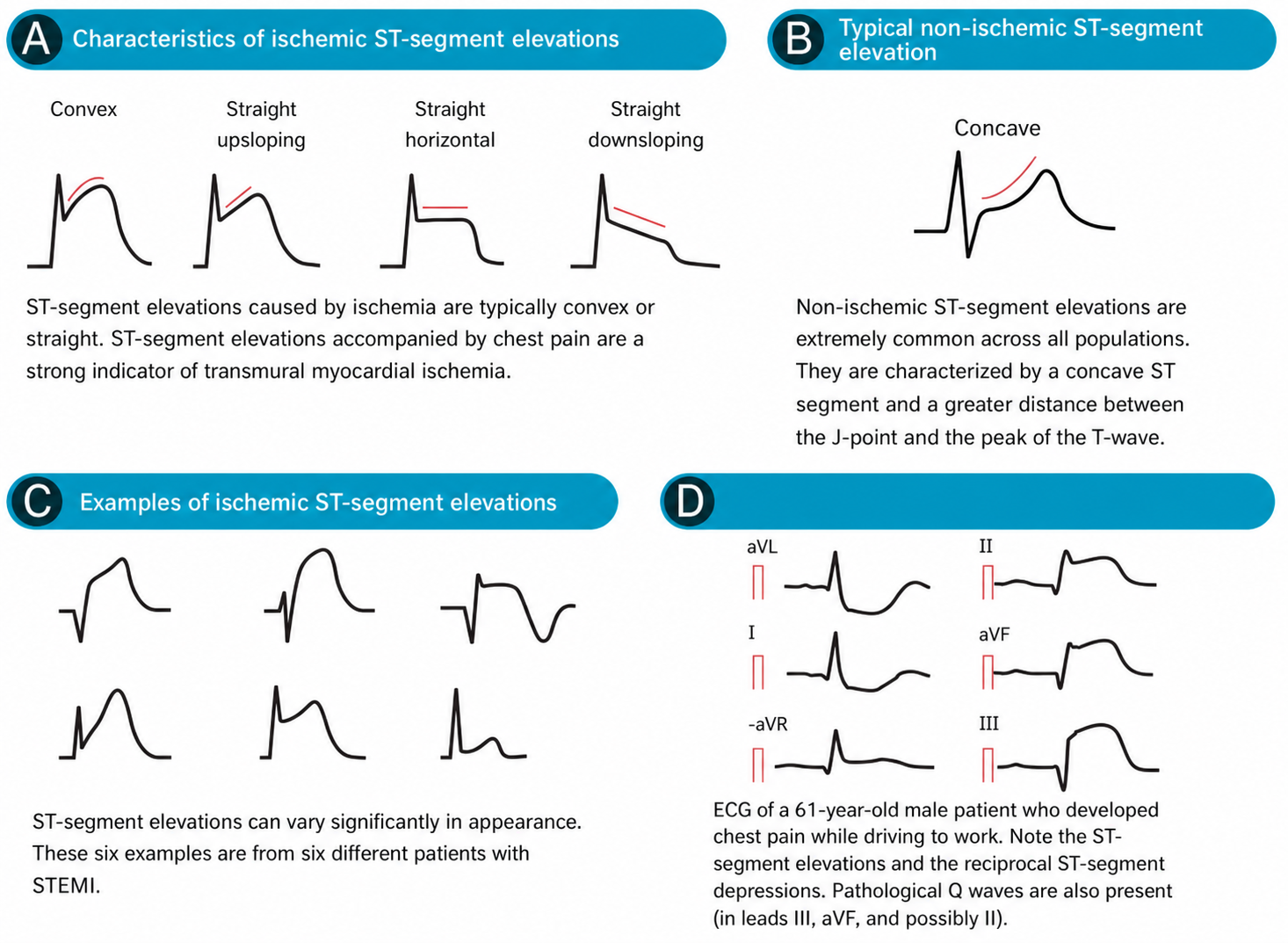 Ischemic vs. Non-Ischemic ST-Segment Elevation & Examples