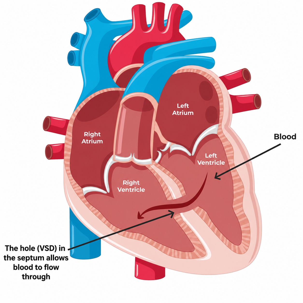 Ventricular Septal Defect (VSD) Diagram