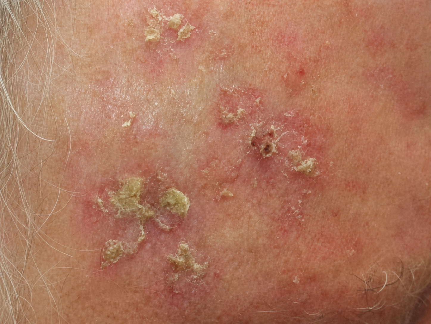 Multiple actinic keratoses on sun-exposed skin