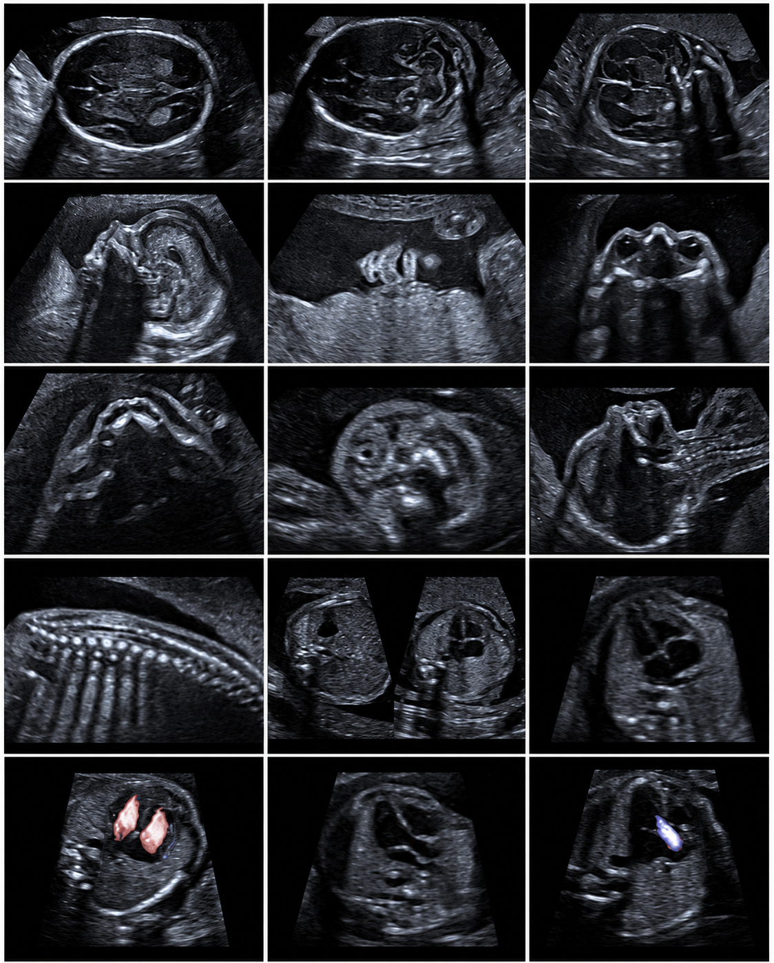Fetal anomaly scan ultrasound